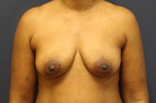 Breast Augmentation Before Photo by Laurence Glickman, MD, MSc, FRCS(c),  FACS; Garden City, NY - Case 34915