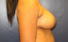 Breast Augmentation After Photo by Laurence Glickman, MD, MSc, FRCS(c),  FACS; Garden City, NY - Case 34915