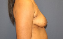 Breast Augmentation Before Photo by Laurence Glickman, MD, MSc, FRCS(c),  FACS; Garden City, NY - Case 34915