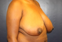 Breast Reduction Before Photo by Laurence Glickman, MD, MSc, FRCS(c),  FACS; Garden City, NY - Case 34917