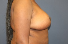 Breast Reduction After Photo by Laurence Glickman, MD, MSc, FRCS(c),  FACS; Garden City, NY - Case 34917