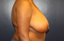 Breast Reduction Before Photo by Laurence Glickman, MD, MSc, FRCS(c),  FACS; Garden City, NY - Case 34917