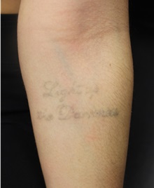 Tattoo Removal Before Photo by Laurence Glickman, MD, MSc, FRCS(c),  FACS; Garden City, NY - Case 34929