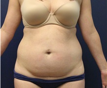 Tummy Tuck Before Photo by Laurence Glickman, MD, MSc, FRCS(c),  FACS; Garden City, NY - Case 34931