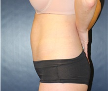 Tummy Tuck After Photo by Laurence Glickman, MD, MSc, FRCS(c),  FACS; Garden City, NY - Case 34931