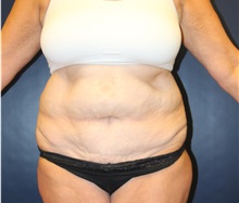 Tummy Tuck Before Photo by Laurence Glickman, MD, MSc, FRCS(c),  FACS; Garden City, NY - Case 34932