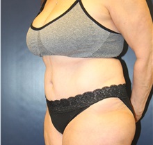 Tummy Tuck After Photo by Laurence Glickman, MD, MSc, FRCS(c),  FACS; Garden City, NY - Case 34932
