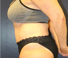 Tummy Tuck After Photo by Laurence Glickman, MD, MSc, FRCS(c),  FACS; Garden City, NY - Case 34932