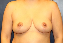 Breast Lift After Photo by Laurence Glickman, MD, MSc, FRCS(c),  FACS; Garden City, NY - Case 34935