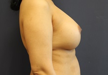 Breast Augmentation After Photo by Laurence Glickman, MD, MSc, FRCS(c),  FACS; Garden City, NY - Case 34936