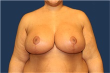 Breast Reduction After Photo by Laurence Glickman, MD, MSc, FRCS(c),  FACS; Garden City, NY - Case 34968