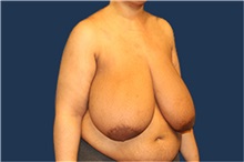 Breast Reduction Before Photo by Laurence Glickman, MD, MSc, FRCS(c),  FACS; Garden City, NY - Case 34968