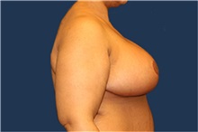 Breast Reduction After Photo by Laurence Glickman, MD, MSc, FRCS(c),  FACS; Garden City, NY - Case 34968