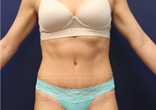 Tummy Tuck After Photo by Laurence Glickman, MD, MSc, FRCS(c),  FACS; Garden City, NY - Case 35320
