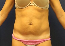 Tummy Tuck Before Photo by Laurence Glickman, MD, MSc, FRCS(c),  FACS; Garden City, NY - Case 35320