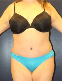 Tummy Tuck After Photo by Laurence Glickman, MD, MSc, FRCS(c),  FACS; Garden City, NY - Case 36313