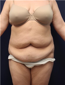 Tummy Tuck Before Photo by Laurence Glickman, MD, MSc, FRCS(c),  FACS; Garden City, NY - Case 36313