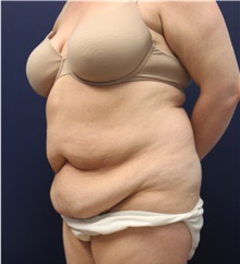 Tummy Tuck Before Photo by Laurence Glickman, MD, MSc, FRCS(c),  FACS; Garden City, NY - Case 36313