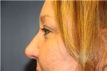 Eyelid Surgery After Photo by Laurence Glickman, MD, MSc, FRCS(c),  FACS; Garden City, NY - Case 36315