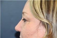 Eyelid Surgery Before Photo by Laurence Glickman, MD, MSc, FRCS(c),  FACS; Garden City, NY - Case 36315