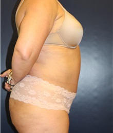 Tummy Tuck After Photo by Laurence Glickman, MD, MSc, FRCS(c),  FACS; Garden City, NY - Case 36316