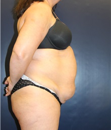 Tummy Tuck Before Photo by Laurence Glickman, MD, MSc, FRCS(c),  FACS; Garden City, NY - Case 36316