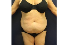 Tummy Tuck Before Photo by Laurence Glickman, MD, MSc, FRCS(c),  FACS; Garden City, NY - Case 36317