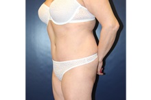 Tummy Tuck After Photo by Laurence Glickman, MD, MSc, FRCS(c),  FACS; Garden City, NY - Case 36317