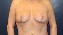 Breast Reduction After Photo by Laurence Glickman, MD, MSc, FRCS(c),  FACS; Garden City, NY - Case 36318