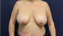 Breast Reduction Before Photo by Laurence Glickman, MD, MSc, FRCS(c),  FACS; Garden City, NY - Case 36318