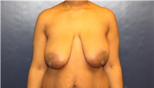 Breast Reduction Before Photo by Laurence Glickman, MD, MSc, FRCS(c),  FACS; Garden City, NY - Case 36319