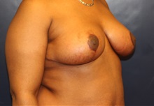 Breast Reduction After Photo by Laurence Glickman, MD, MSc, FRCS(c),  FACS; Garden City, NY - Case 36319
