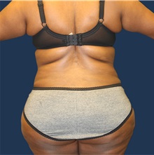 Liposuction After Photo by Laurence Glickman, MD, MSc, FRCS(c),  FACS; Garden City, NY - Case 36321