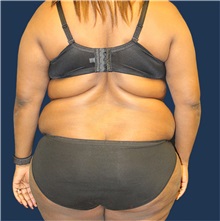 Liposuction Before Photo by Laurence Glickman, MD, MSc, FRCS(c),  FACS; Garden City, NY - Case 36321