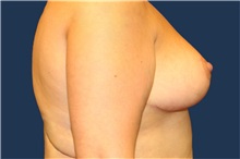 Breast Reduction After Photo by Laurence Glickman, MD, MSc, FRCS(c),  FACS; Garden City, NY - Case 36323
