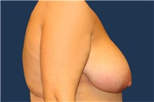 Breast Reduction Before Photo by Laurence Glickman, MD, MSc, FRCS(c),  FACS; Garden City, NY - Case 36323