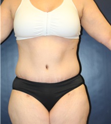 Tummy Tuck After Photo by Laurence Glickman, MD, MSc, FRCS(c),  FACS; Garden City, NY - Case 36324