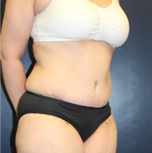 Tummy Tuck After Photo by Laurence Glickman, MD, MSc, FRCS(c),  FACS; Garden City, NY - Case 36324