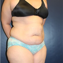 Tummy Tuck Before Photo by Laurence Glickman, MD, MSc, FRCS(c),  FACS; Garden City, NY - Case 36324