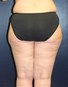 Liposuction After Photo by Laurence Glickman, MD, MSc, FRCS(c),  FACS; Garden City, NY - Case 36325