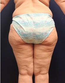 Liposuction Before Photo by Laurence Glickman, MD, MSc, FRCS(c),  FACS; Garden City, NY - Case 36325