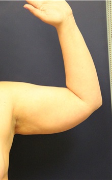 Liposuction Before Photo by Laurence Glickman, MD, MSc, FRCS(c),  FACS; Garden City, NY - Case 36326