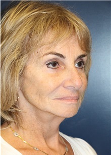 Facelift After Photo by Laurence Glickman, MD, MSc, FRCS(c),  FACS; Garden City, NY - Case 36327