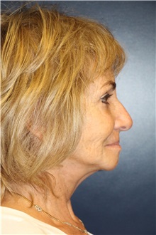 Facelift After Photo by Laurence Glickman, MD, MSc, FRCS(c),  FACS; Garden City, NY - Case 36327