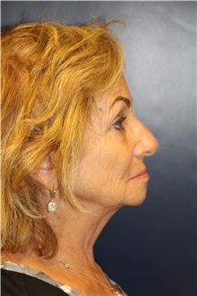 Facelift Before Photo by Laurence Glickman, MD, MSc, FRCS(c),  FACS; Garden City, NY - Case 36327