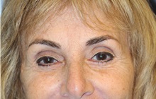Eyelid Surgery After Photo by Laurence Glickman, MD, MSc, FRCS(c),  FACS; Garden City, NY - Case 36328
