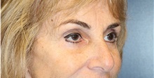 Eyelid Surgery After Photo by Laurence Glickman, MD, MSc, FRCS(c),  FACS; Garden City, NY - Case 36328