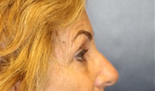 Eyelid Surgery Before Photo by Laurence Glickman, MD, MSc, FRCS(c),  FACS; Garden City, NY - Case 36328