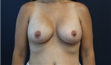 Breast Augmentation After Photo by Laurence Glickman, MD, MSc, FRCS(c),  FACS; Garden City, NY - Case 36329