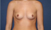 Breast Augmentation Before Photo by Laurence Glickman, MD, MSc, FRCS(c),  FACS; Garden City, NY - Case 36329